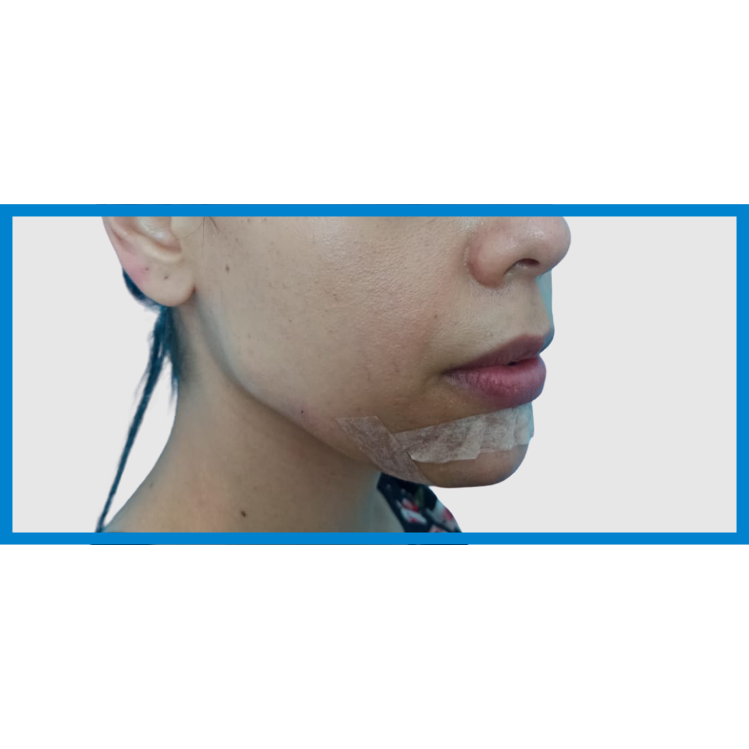 After-Linea Mandibular