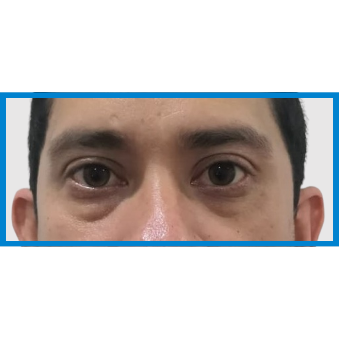 Before-Bolsas de ojos 