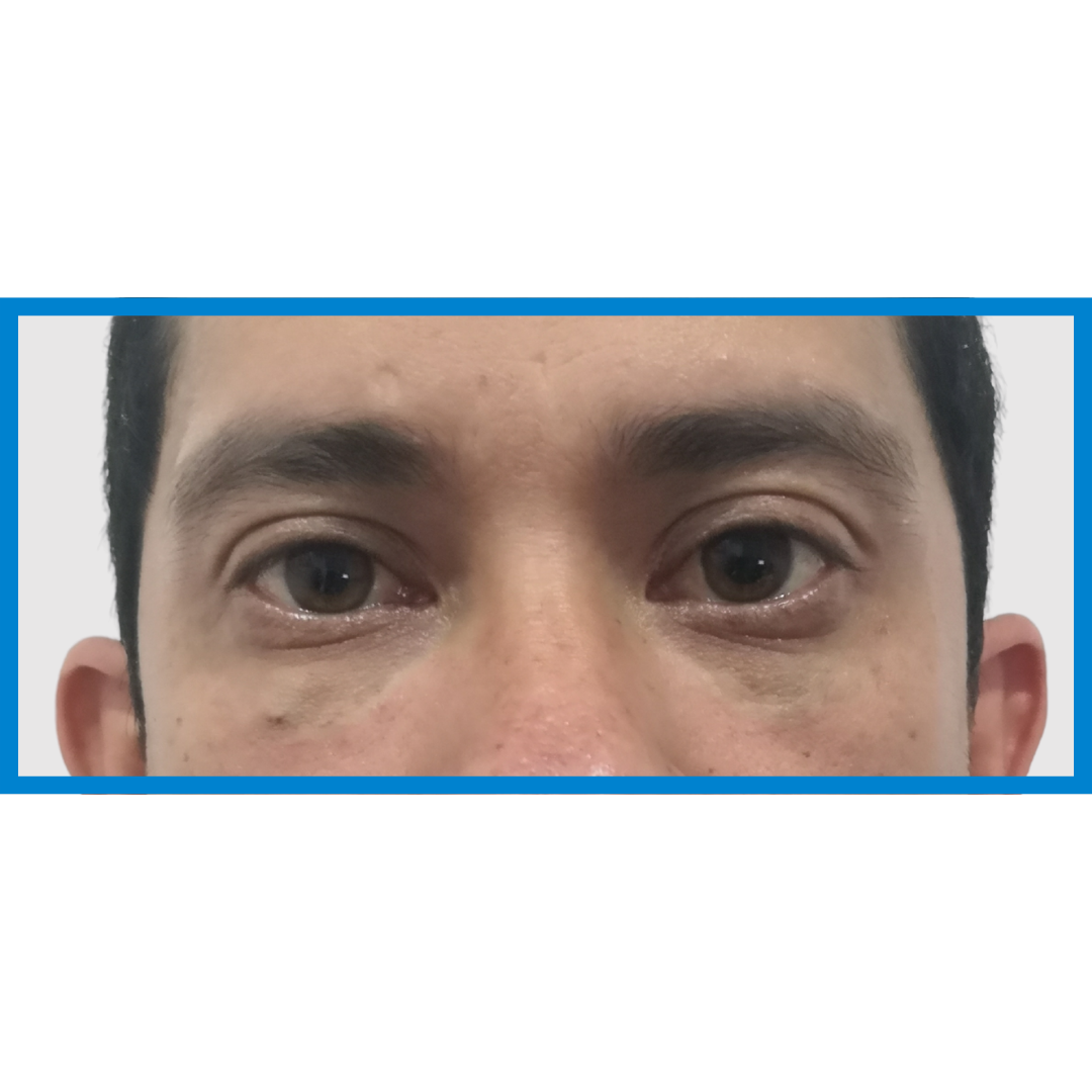 After-Bolsas de ojos 