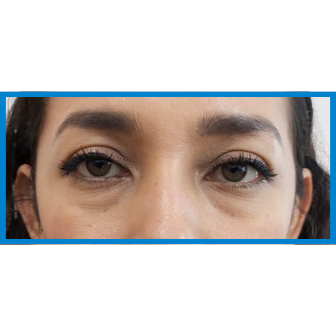 Before-Bolsas de ojos 