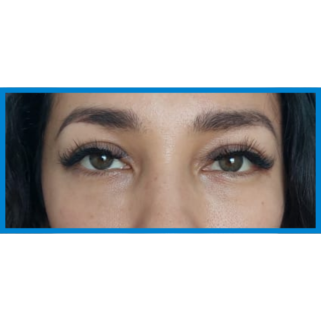 After-Bolsas de ojos 