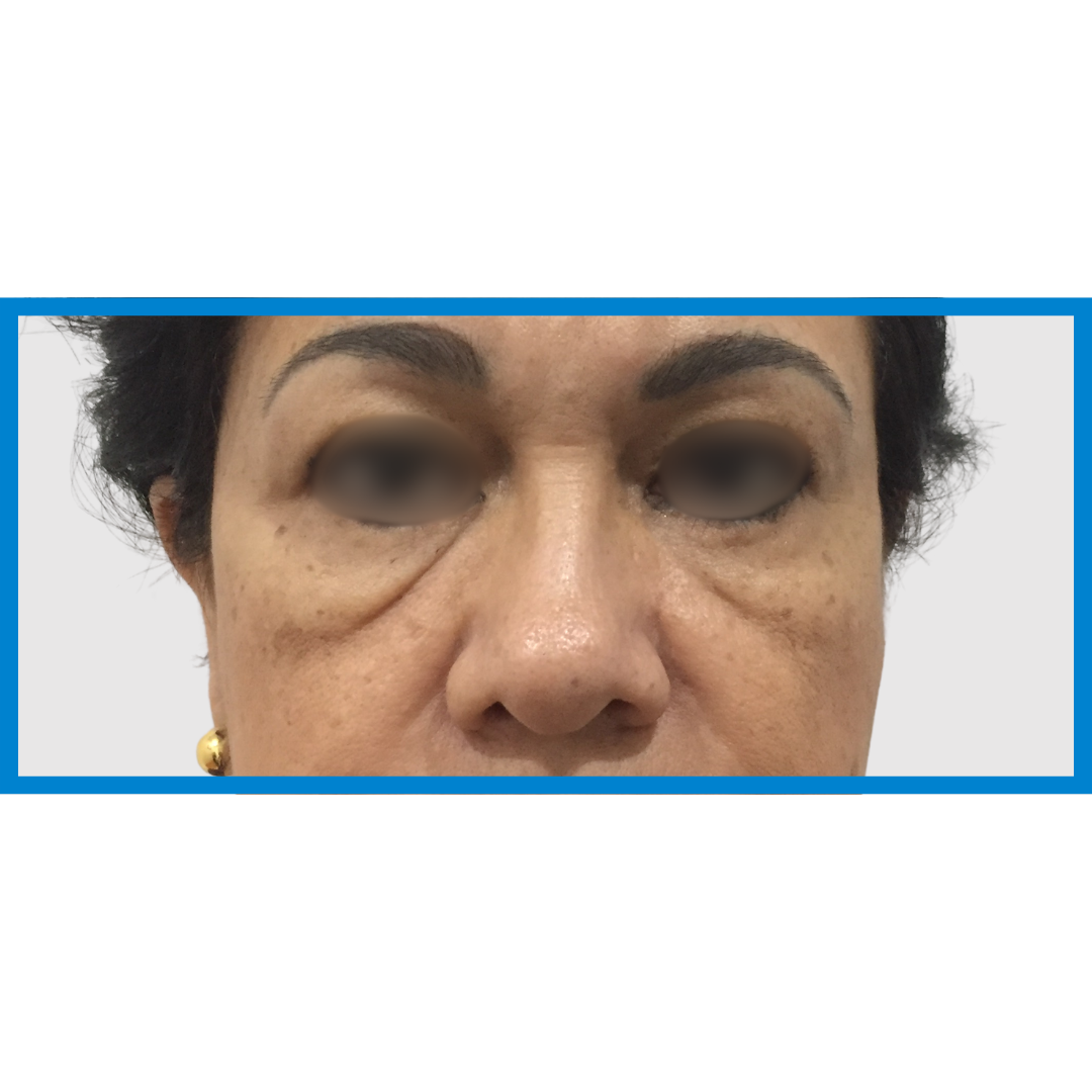 Before-Surco Nayugal