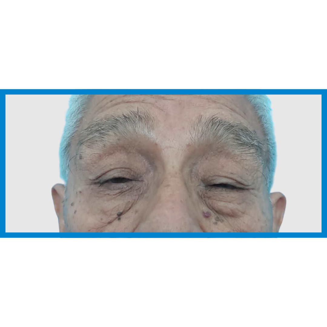 Before- Ptosis Palpebral