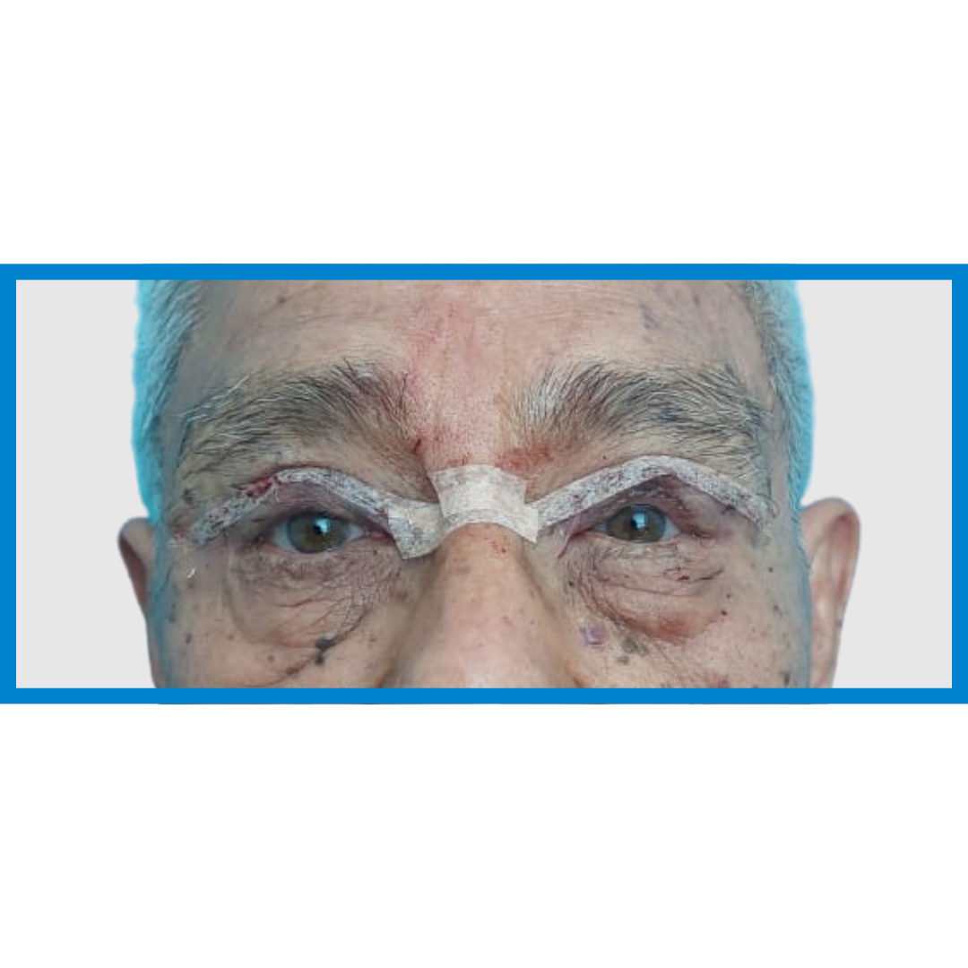 After- Ptosis Palpebral