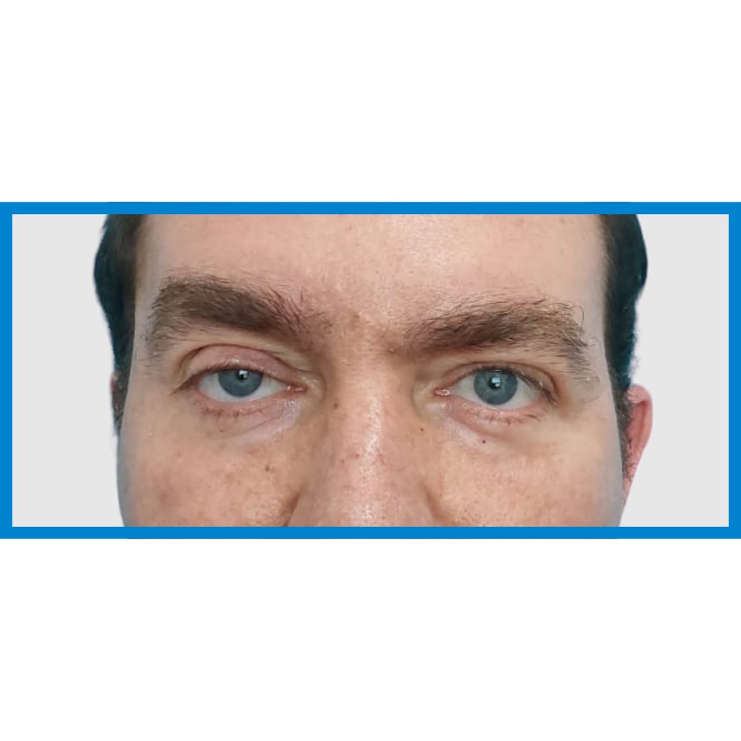 Before-Ptosis Palpebral