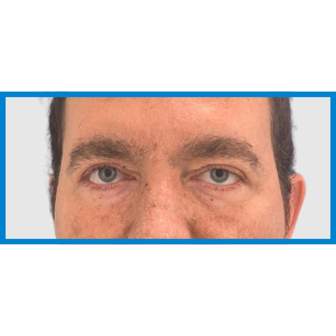 After-Ptosis Palpebral