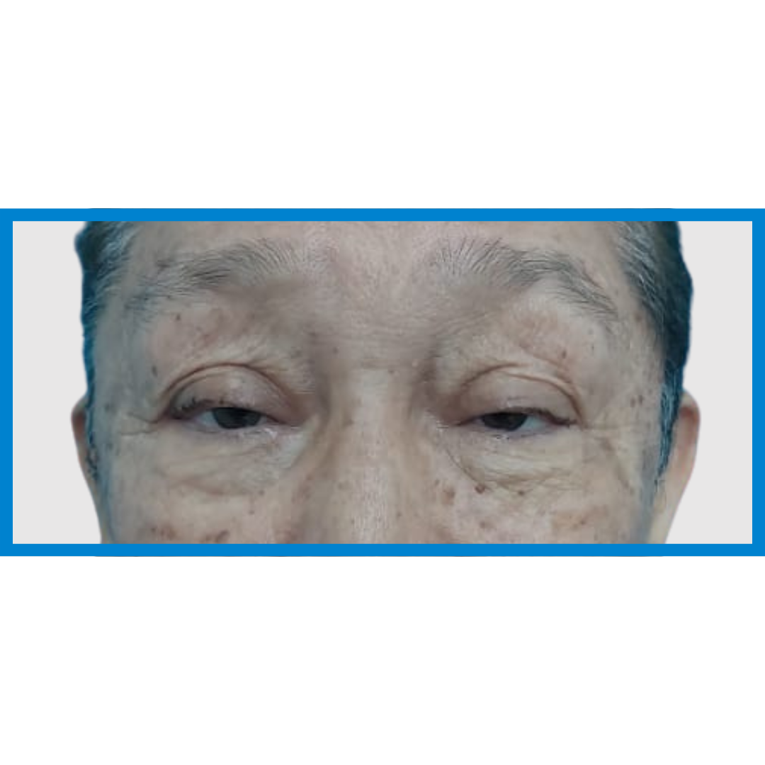 Before-Ptosis Palpebral