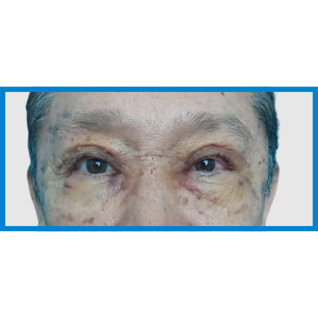 After-Ptosis Palpebral